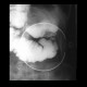 Resection of oesophagus, colon interponat, anastomosis: RF - Fluoroscopy